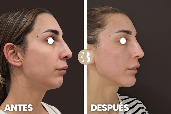 antes y después marcación mandibular