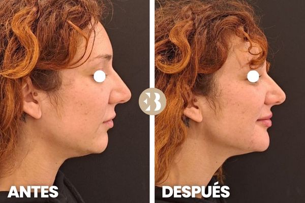 antes y después marcación mandibular