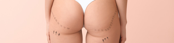 aumento de glúteos acido hialurónico