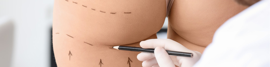 aumento de gluteos sin cirugia