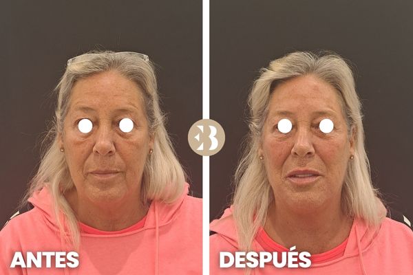 aumento de pómulos antes y después