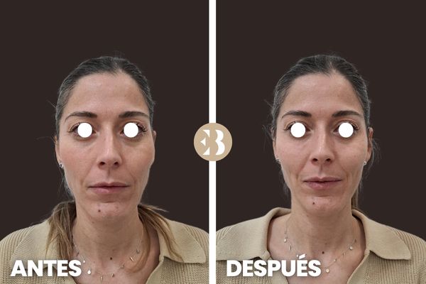 aumento de pómulos antes y después