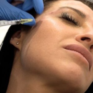 por que salen las arrugas y como eliminarlas. Tratamiento con botox por que salen las arrugas y como eliminarlas. Tratamiento con botox