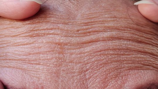 eliminar arrugas cara. Tratamientos para rejuvenecer el rostro en la Clinica de Medicina Estética EB en Madrid