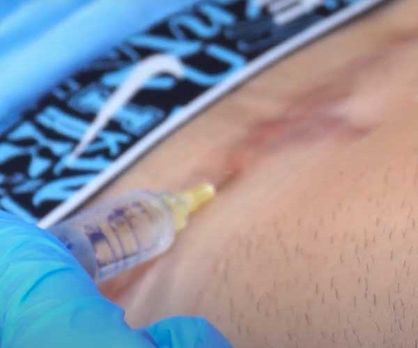 enzimas elimina cicatrices y estrias