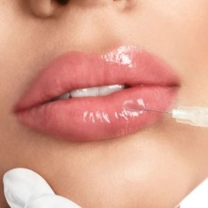 Ácido hialurónico labios en la clinica de medicina estetica eb Ácido hialurónico labios en la clinica de medicina estetica eb