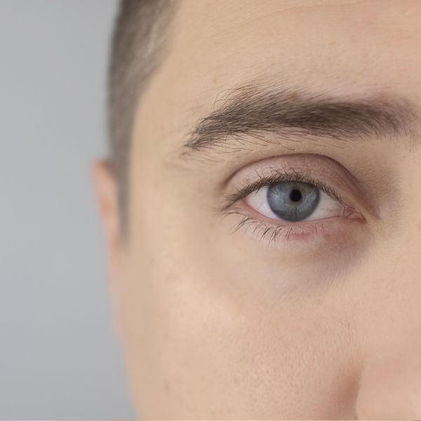 relleno de ojeras con acido hialuronico