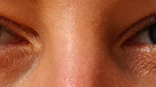 ácido hialurónico para ojeras