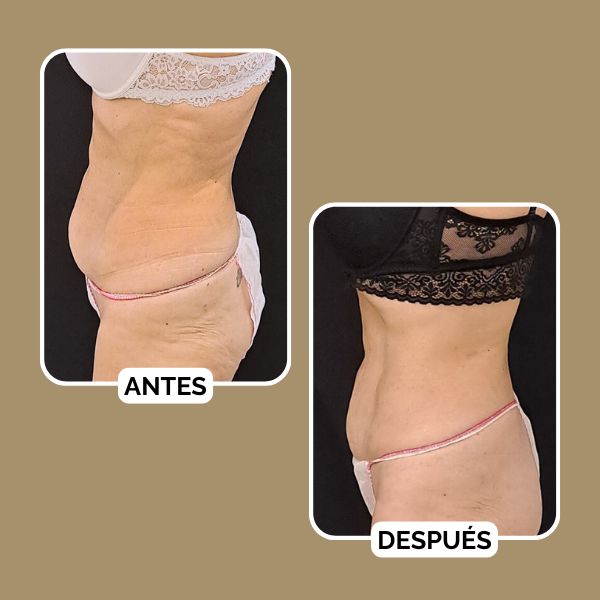 antes y después tratamiento corporal