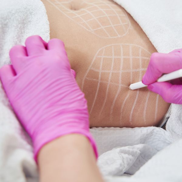 Intralipoterapia eliminar grasa localizada