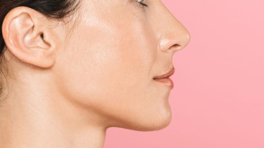 marcación mandibular sin cirugía tratamiento con acido hialuronico