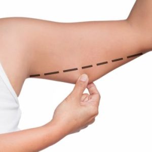 mesoterapia corporal alydia en brazos mesoterapia corporal alydia en brazos