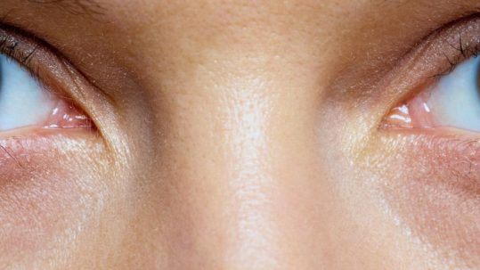 ojeras oscuras quitarlas con tratamiento medico estetico