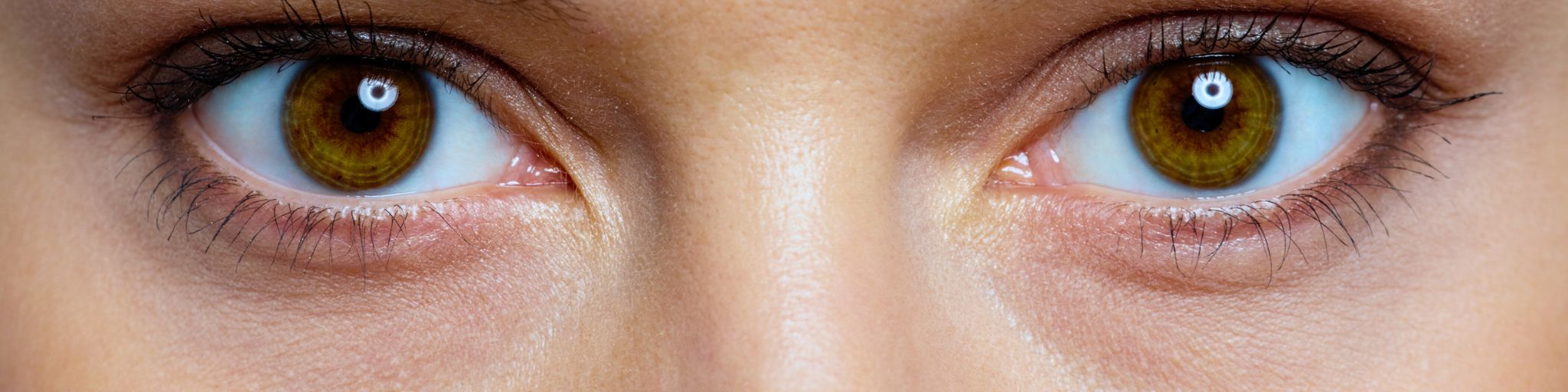 ojeras oscuras quitarlas con tratamiento medico estetico