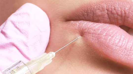 pinchar labios con acido hialuronico