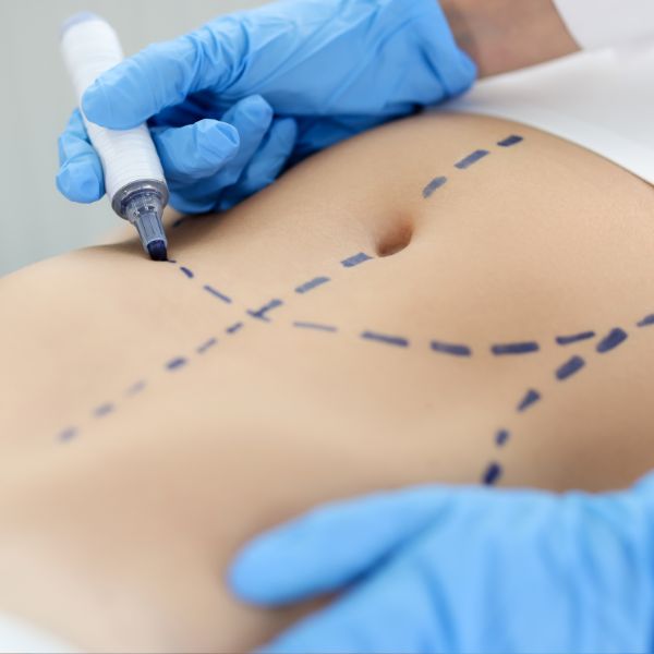 quitar grasa abdominal mujer tratamiento con criolipolisis