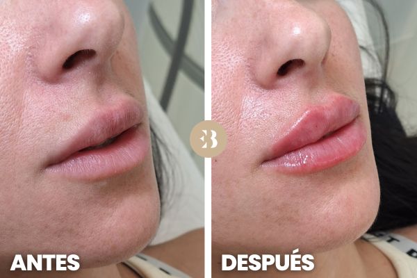 Foto Antes y Después Aumento de Labios en la clínica de medicina estética Dra Elena Berezo