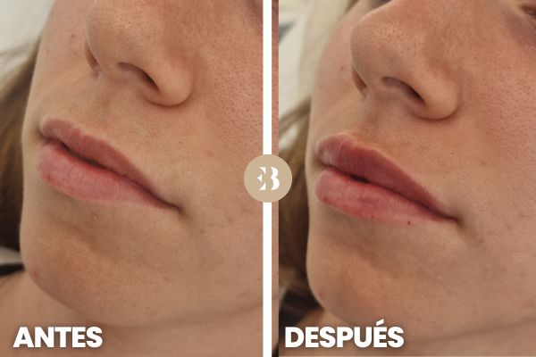 Foto Antes y Después Aumento de Labios en la clínica de medicina estética Dra Elena Berezo