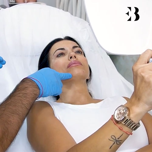 Bioestimuladores de colágeno. Paciente de las Clínicas de Medicina Estética EB
