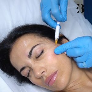 Bioestimuladores de colágeno. Paciente de las Clínicas de Medicina Estética EB