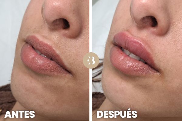 Relleno de Labios Antes y después en la clínica de medicina estética Dra Elena Berezo