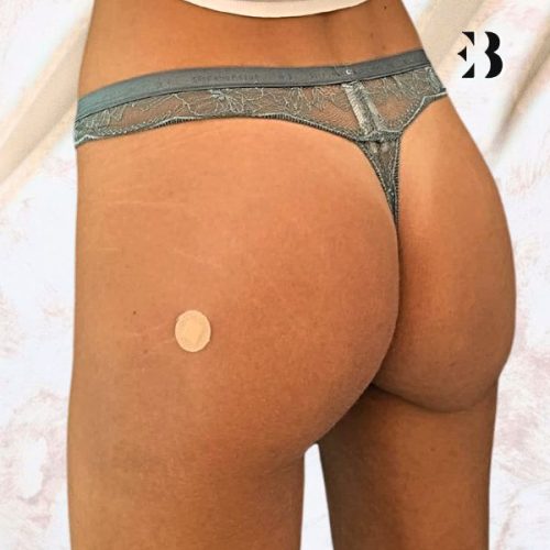 Aumento de glúteos Madrid. Caso Real Paciente Clinica EB