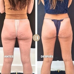 Criolipolisis cartucheras antes y después