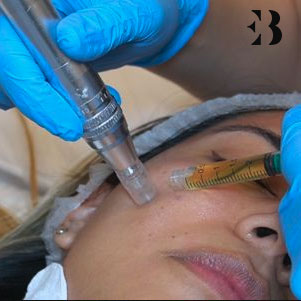 Dermapen paciente Clínica EB