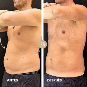 eliminar grasa abdomen antes y después