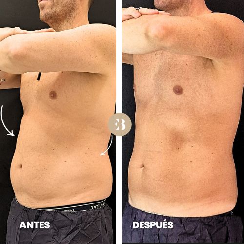 eliminar grasa abdomen antes y después