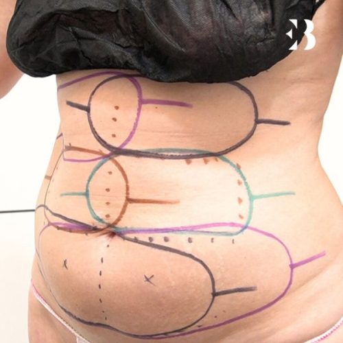 Eliminar grasa localizada en Madrid