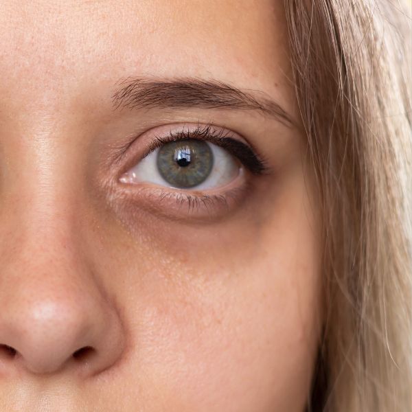 eliminar ojeras en la clínica medicina estética en EB
