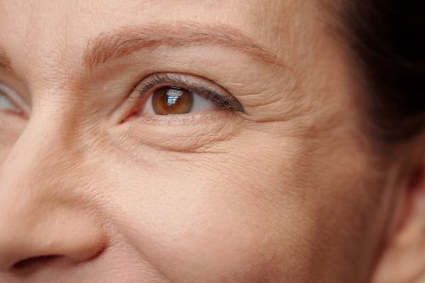 eliminar ojeras con acido hialuronico en la clinica de medicina estética EB