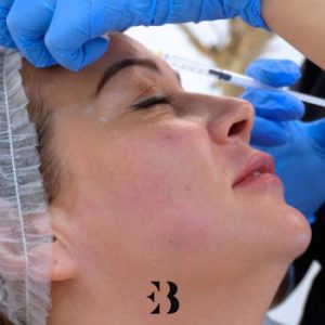 hidroxiapatita cálcica tratamiento Radiesse