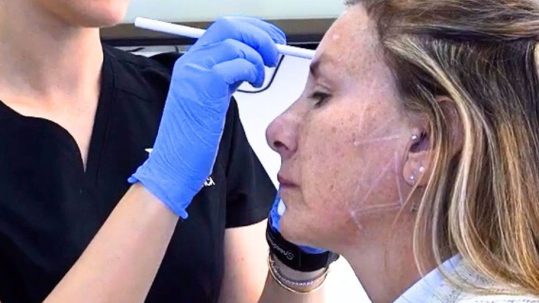 Hidroxiapatita Cálcica Radiesse