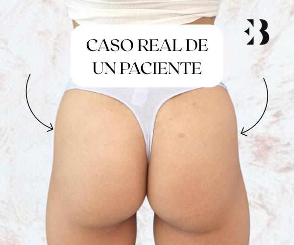 hip dips con acido hialuronico caso eb