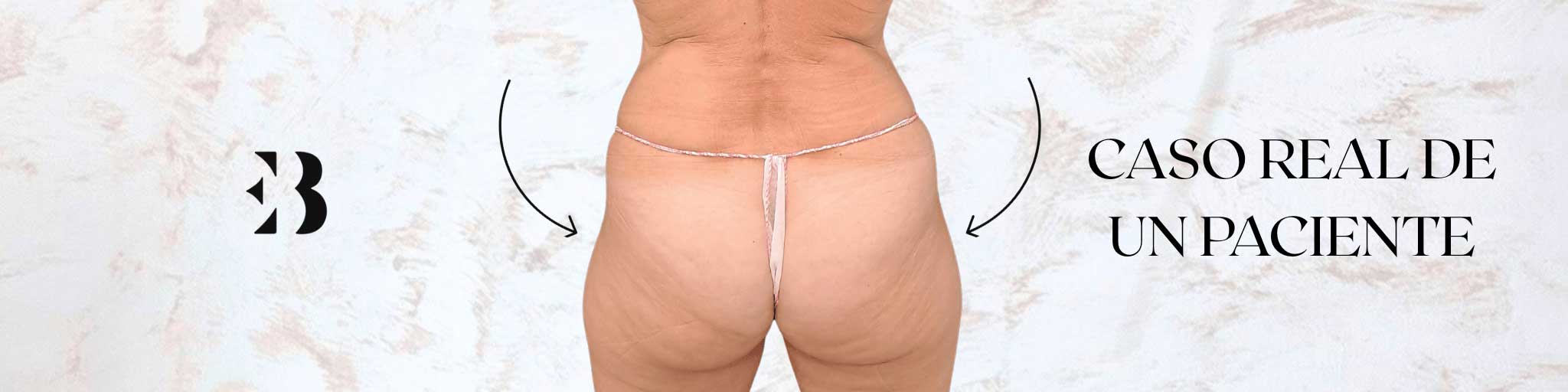 hip dips con acido hialuronico caso real eb