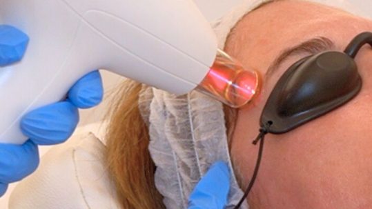 Laser IPL facial en la clinica de medicina estetica EB