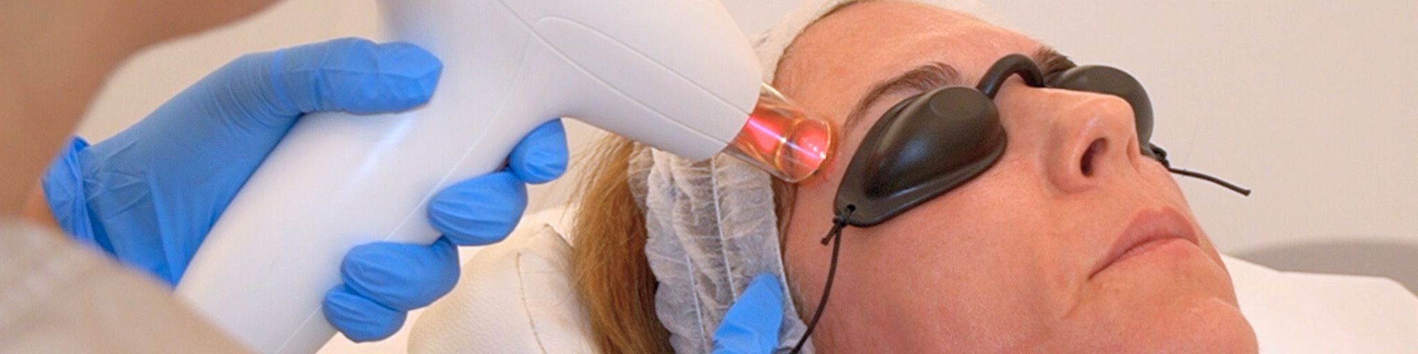 Laser IPL facial en la clinica de medicina estetica EB