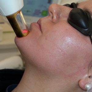 Láser IPL Facial en Madrid en la Clínica de Medicina Estética Dra Elena Berezo