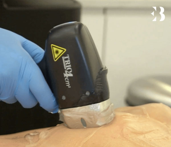 Depilación Láser con Omar y el Láser Soprano Titanium en Clínicas EB