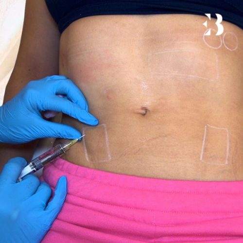 mesoterapia corporal precio