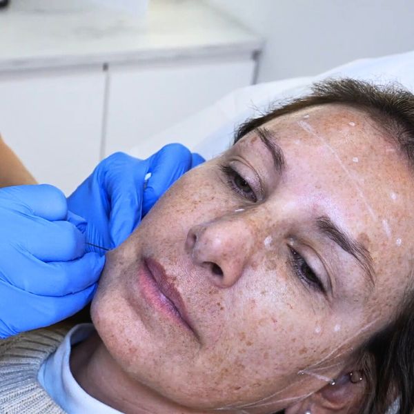 Sculptra- Tratamiento Inductor de Colágeno Paciente Clinica EB