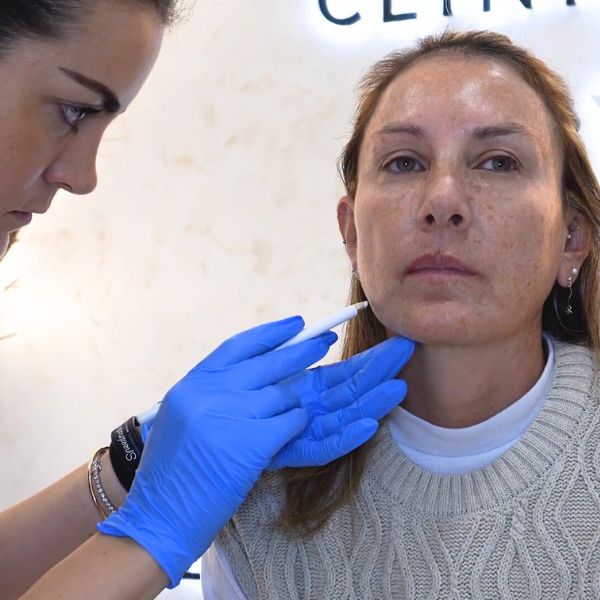 Sculptra- Tratamiento Inductor de Colágeno Paciente Clinica EB