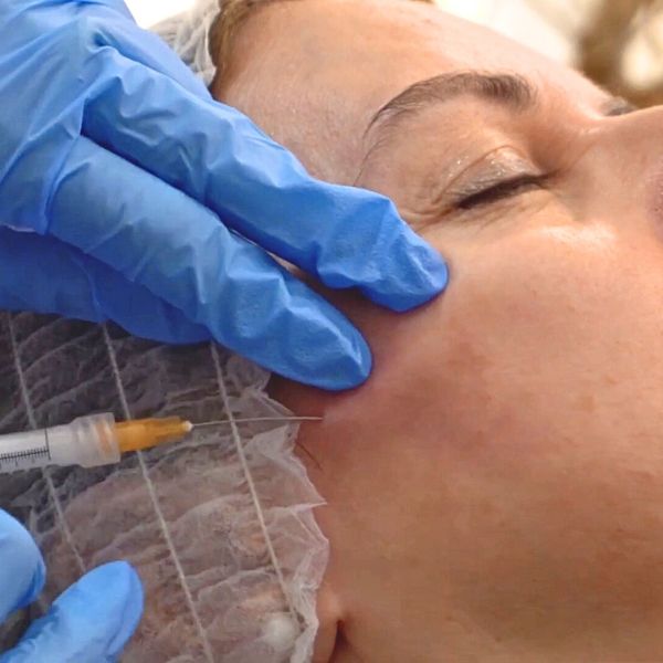 sculptra inductor colageno tratamiento paciente EB