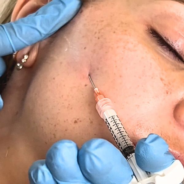 Tratamiento Tratamiento Inductor de Colágeno Paciente Clinica EB