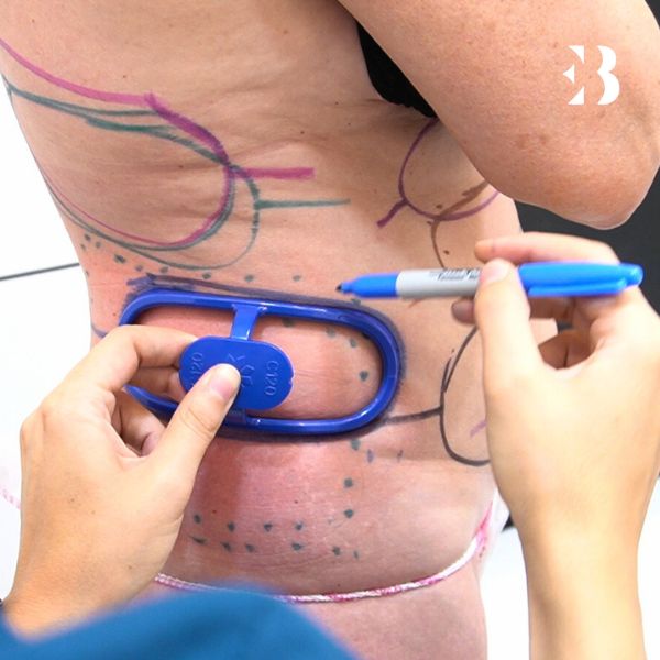 láser ipl facial - Resurfacing