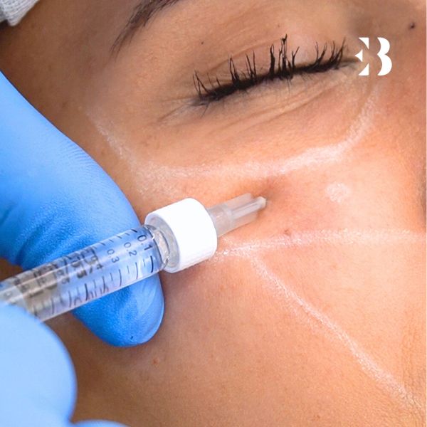 inductor colágeno para el tratamiento facial en la clinica de medicina estetica EB