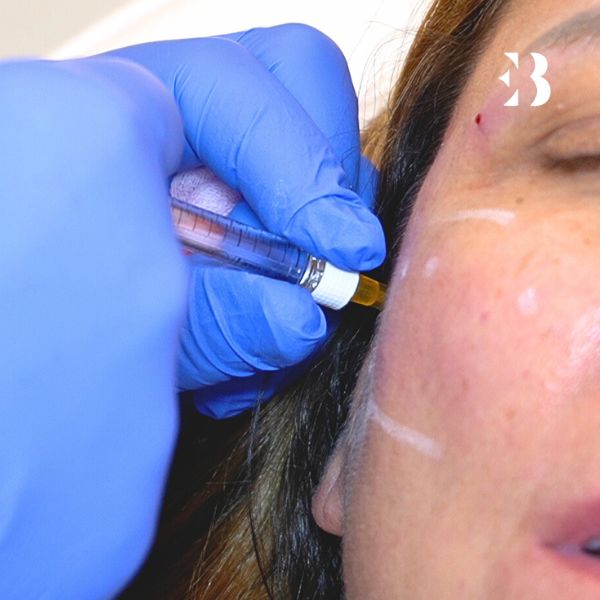 precio del inductor colágeno para el tratamiento facial en la clinica de medicina estetica EB