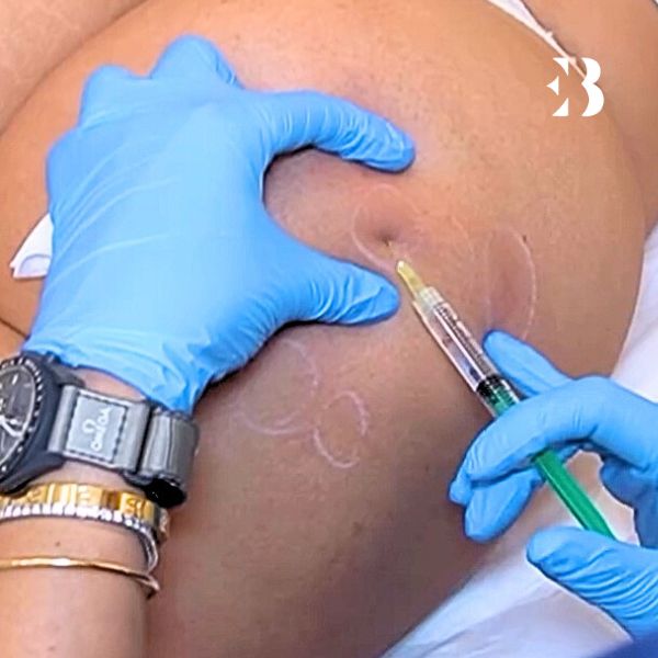 inductor colágeno en Salamanca para el tratamiento gluteo en la clinica de medicina estetica EB